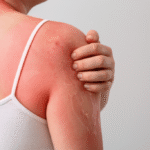 woman with severe sunburn